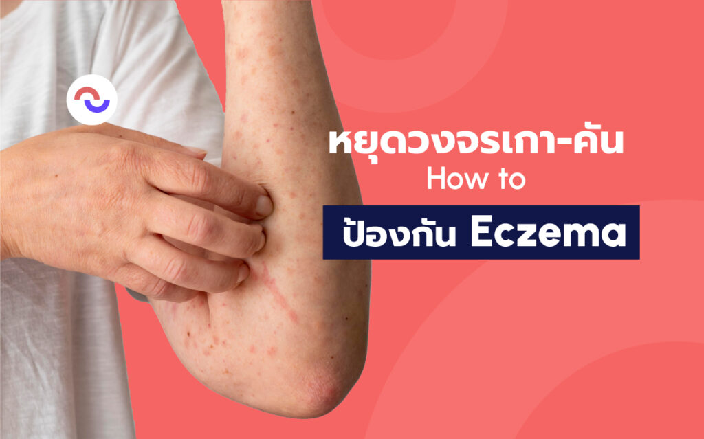 วิธีป้องกัน Eczema